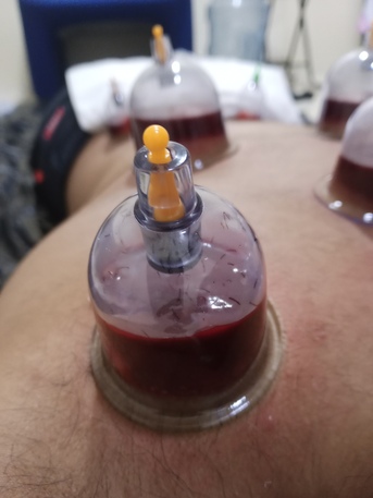 Jubail, Health & Beauty Items, SAR 100,  Hijama Cupping/Cupping Therapy