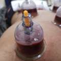 SAR 100,  Hijama Cupping/Cupping Therapy