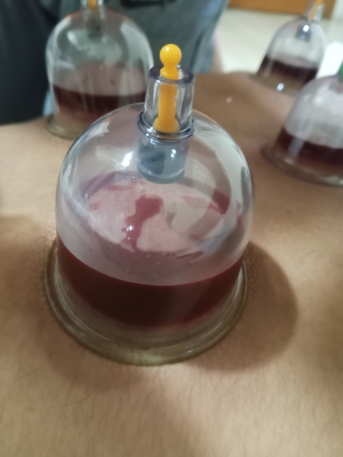 Jubail, Health & Beauty Items, SAR 100,  Hijama Cupping/Cupping Therapy