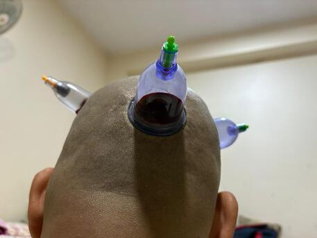 Jubail, Health & Beauty Items, SAR 100,  Hijama Cupping/Cupping Therapy