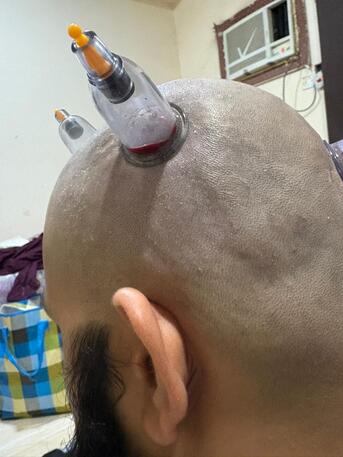 Jubail, Health & Beauty Items, SAR 100,  Hijama Cupping/Cupping Therapy