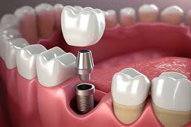 Singapore, Dental, 6 Benefits Of Choosing Dental Implants