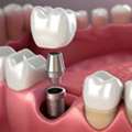 6 Benefits Of Choosing Dental Implants