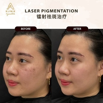 Kuala Lumpur, Beautician, Skin Pigmentation Facial Treatment In KL | Advanced Laser Care At A Klinik