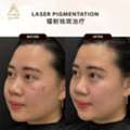 Skin Pigmentation Facial Treatment In KL | Advanced Laser Care At A Klinik