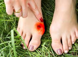 Singapore, Health, How Do You Treat A Toe Bunion At Home? Tips And Tricks That Work!
