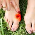 How Do You Treat A Toe Bunion At Home? Tips And Tricks That Work!