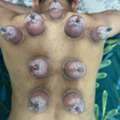Hijama