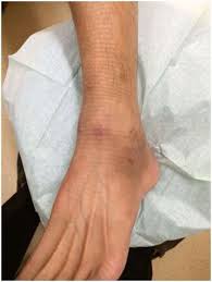 Singapore, Health, The Road To Recovery: Living With An Ankle Ligament Tear