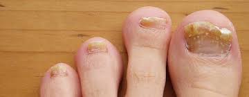 Tokyo, Health & Beauty Items, 40,  Say Goodbye To Nail Fungus With Zetaclear!