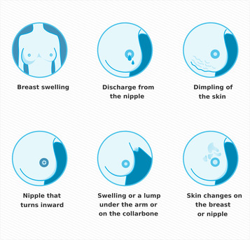 Dubai, General, Breast Cancer: Early Signs, Treatment & Prevention Guide