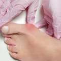Are Home Remedies Effective For Bunion Care?