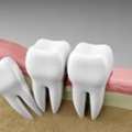 5 Sign Of Extraction Of Wisdom Tooth