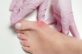 Singapore, Health, Busting Bunions: Your Guide To Effective Treatment
