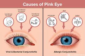 Dubai, General, Is Pink Eye Contagious? How Long It Spreads & Prevention Tips