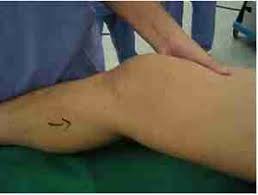 Singapore, Health, Is ACL Surgery Necessary For All Injuries In Singapore?