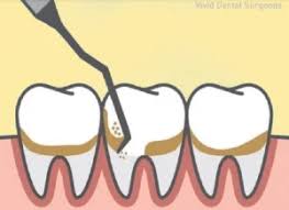 Singapore, Dental, How To Maintain Oral Health After Dental Scaling And Polishing