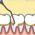 How To Maintain Oral Health After Dental Scaling And Polishing