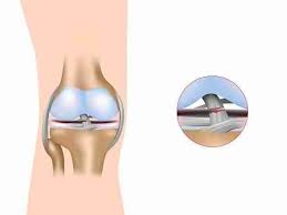 Singapore, Health, 5 Remedies Of Acl Surgery In Singapore