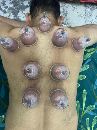 Dammam, Furniture, SAR 120,  Hijama - Home Service