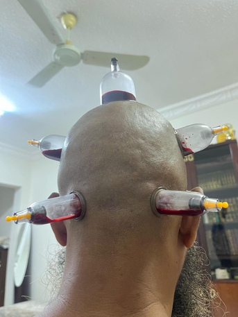 Dammam, Furniture, SAR 120,  Hijama - Home Service