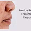 Freckle Removal Treatment In Singapore | Lim Clinic And Surgery, Singapore.
