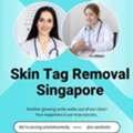 Safe & Fast Skin Tag Removal In Singapore &ndash; Professional, Affordable Service