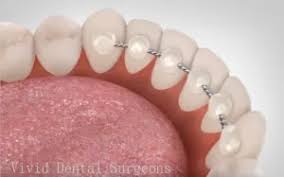 Singapore, Dental, 5 Signs You Might Need A New Retainer