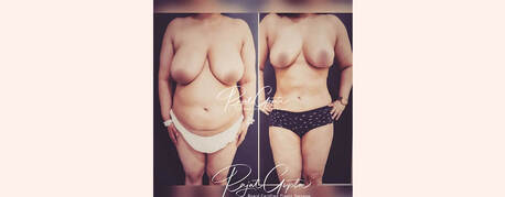 Mumbai, Health, RG Flap Technique Surgery Vs. Other Breast Reduction Methods