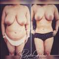 RG Flap Technique Surgery Vs. Other Breast Reduction Methods
