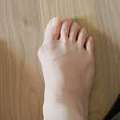 What Are The Symptoms Of Bunions On Feet?