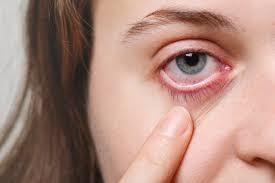 Dubai, General, Understanding Pink Eye Symptoms: Causes, Types & Relief
