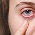 Understanding Pink Eye Symptoms: Causes, Types & Relief