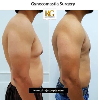 Mumbai, Health, The OCCULT Technique For Gynecomastia