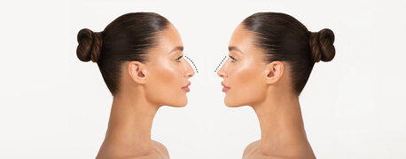 Mumbai, Health, Rhinoplasty Surgery 101: What You Need To Know About Nose Reshaping