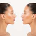 Rhinoplasty Surgery 101: What You Need To Know About Nose Reshaping
