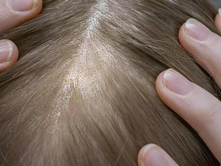 Cali, Health, Hair Transplant Medellin | Skin-Hair Clinic