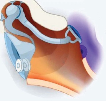 Dubai, Health, Myringotomy Surgery In Dubai | Dr Mustafa Kapadia