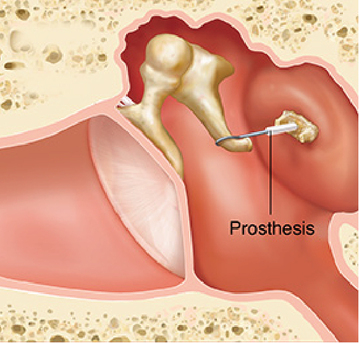 Dubai, Health, Otosclerosis Surgery In Dubai