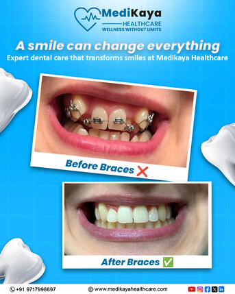 Moscow, Health, Affordable Dental Implants Package In India | Trusted Smile Restoration