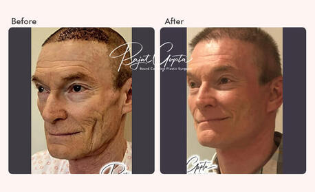 Mumbai, Health, How To Choose The Best Facelift Surgery Clinic In India?
