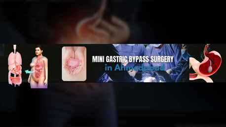 Ahmedabad, Health, Mini Gastric Bypass Surgery For Weight Management In Ahmedabad