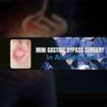 Mini Gastric Bypass Surgery For Weight Management In Ahmedabad