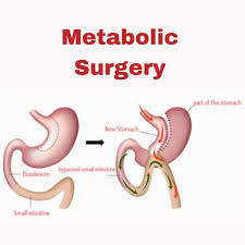 Ahmedabad, Health, Advanced Metabolic Surgery Care In Ahmedabad