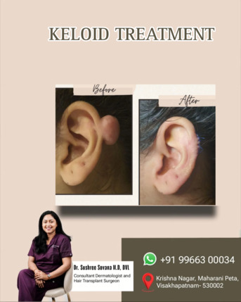  , Keloids Causes And Treatment - Derma One Vizag, 1
