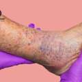 Varicose Veins Specialist In India &ndash; Dr. Dharav Kheradia