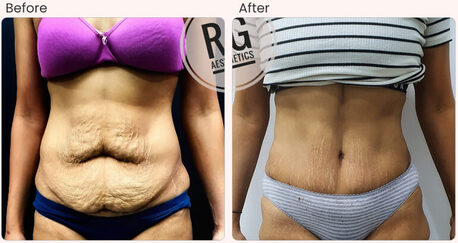 Mumbai, Health, Tummy Tuck Surgery Cost In Delhi - Dr Rajat Gupta