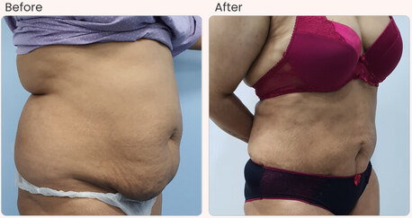 Mumbai, Health, Liposuction Surgery In Delhi - Dr Rajat Gupta