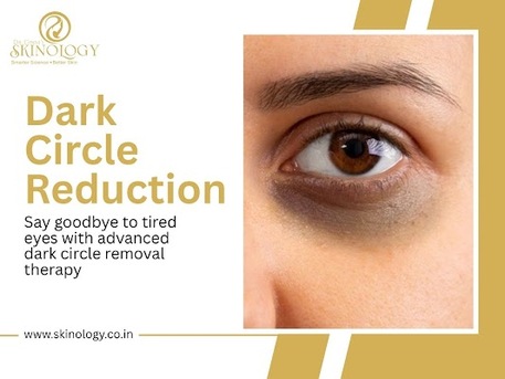 Bhopal, Health, Advanced Dark Circles Reduction Solutions By Experts In Indore