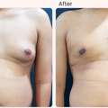 Gynecomastia Surgery Cost In Delhi - Dr Rajat Gupta